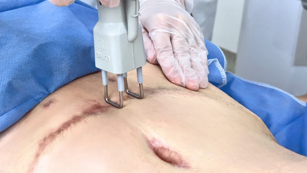 laser co2 para cicatrices